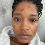 Acne in adulthood: causes and solutions Did you think acne only affected teenagers? It doesn't