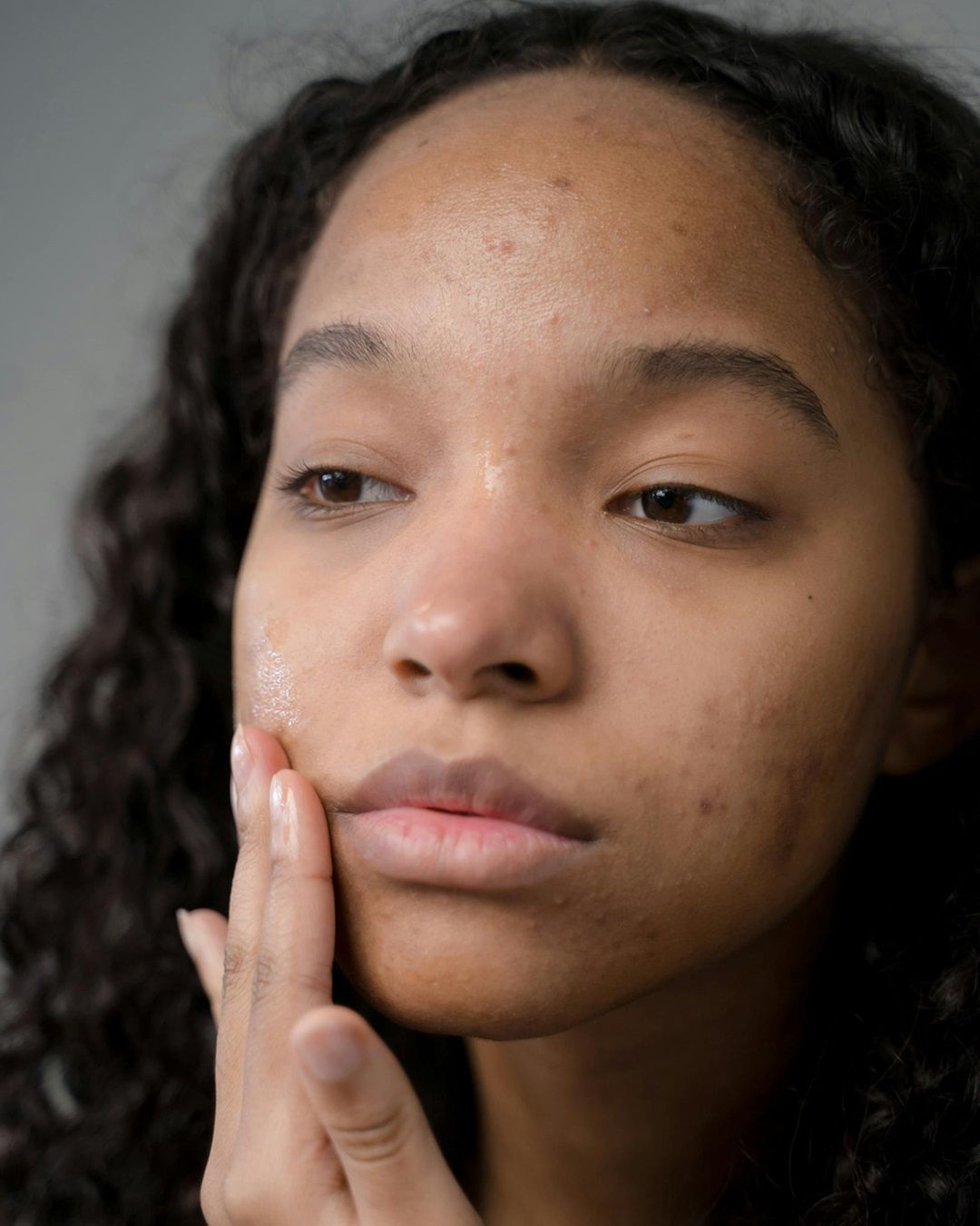 Is acne still a social stigma? New study examines the problem and makes us think about the impact of acne on sufferers