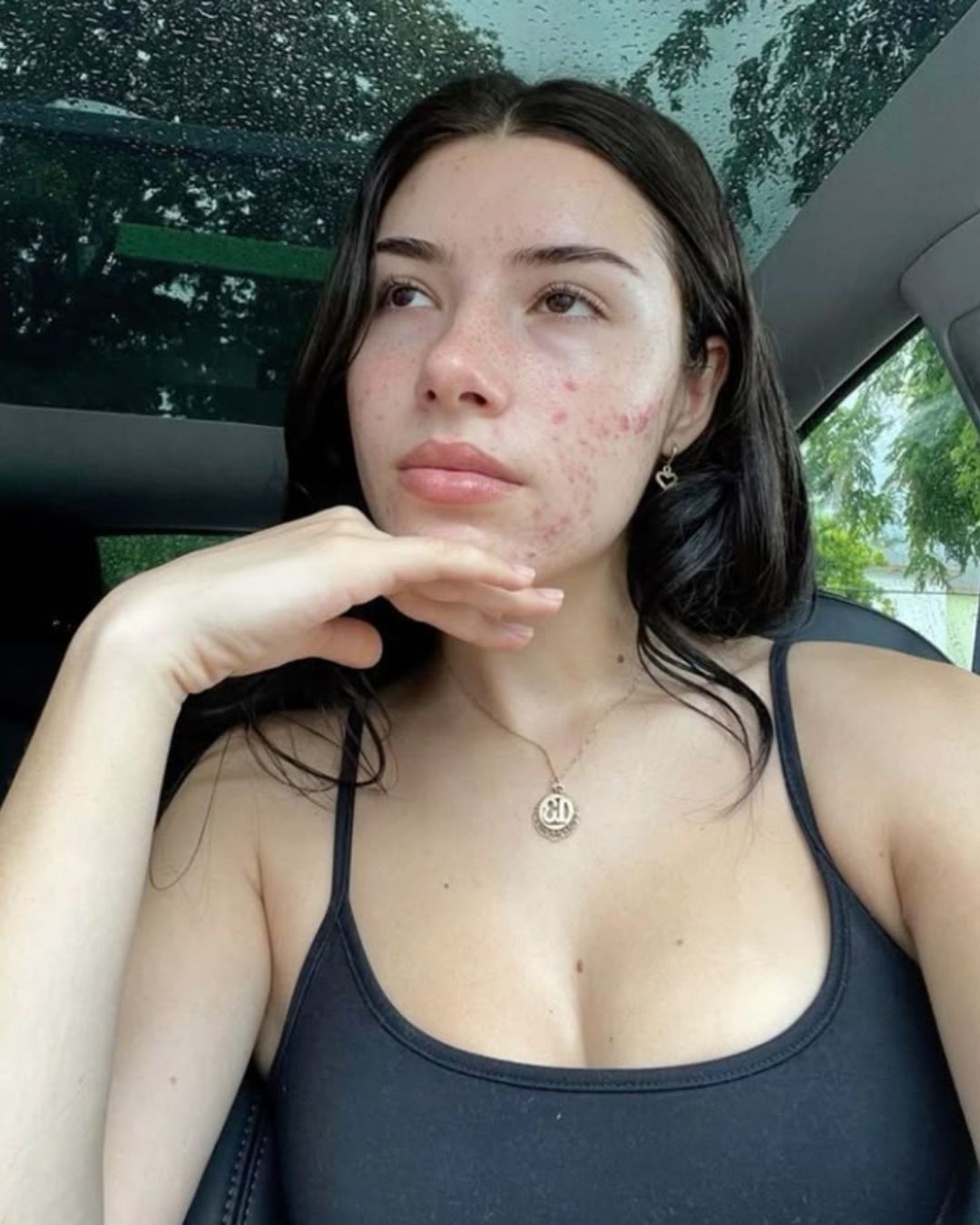 Perioral dermatitis: what it is, how to recognize it and how to treat it We talked about it with Dr. Ines Mordente, here is what she told us